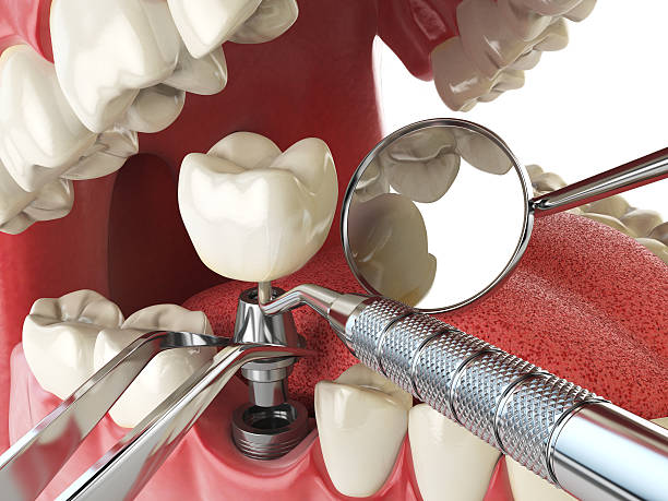 Best Emergency Dental Care for Broken or Chipped Teeth in Midtown, TN